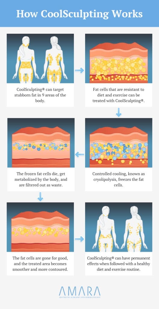 How Does Coolsculpting Work