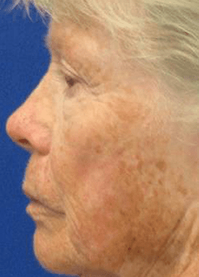 Before Full Face Laser Skin Resurfacing Treatment