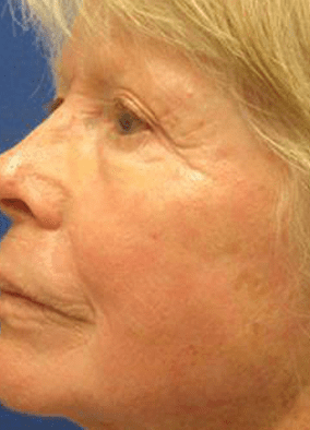 After Full Face Laser Skin Resurfacing Treatment