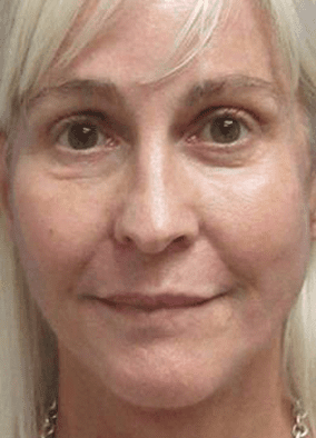 Volbella to Lips After Treatment