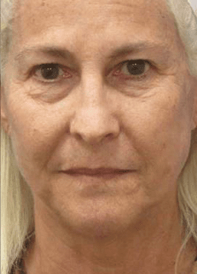 Volbella to Lips Before Treatment