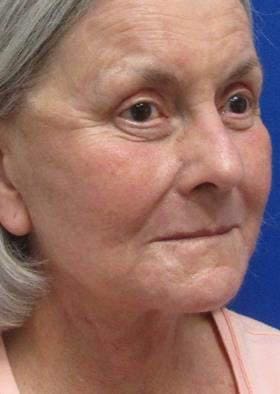 After Full Face Laser Skin Resurfacing Treatment