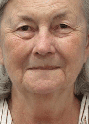 Before Vollure to Marionette Lines Treatment