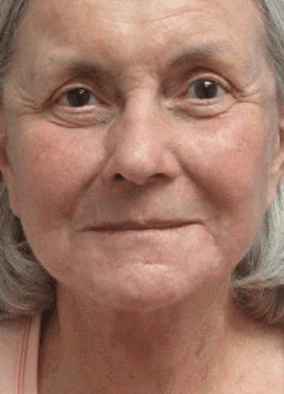 After Vollure to Marionette Lines Treatment