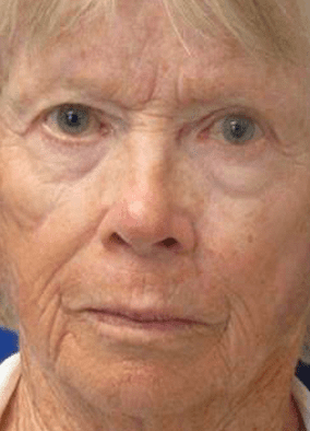 Full Face Laser Skin Resurfacing Treatment After