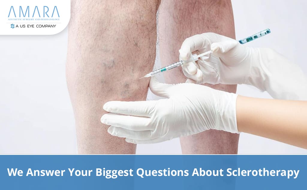 Questions About Sclerotherapy