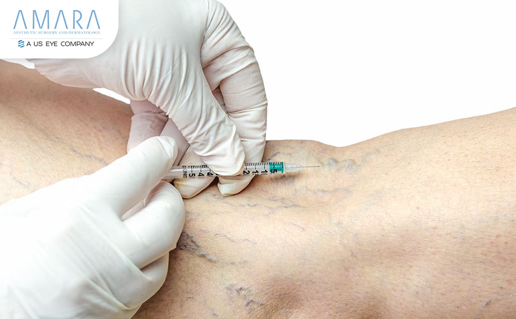 Alternatives to Sclerotherapy