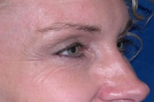 botox_02-new-before-1